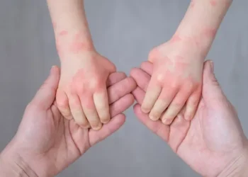 How to Get Rid of Eczema