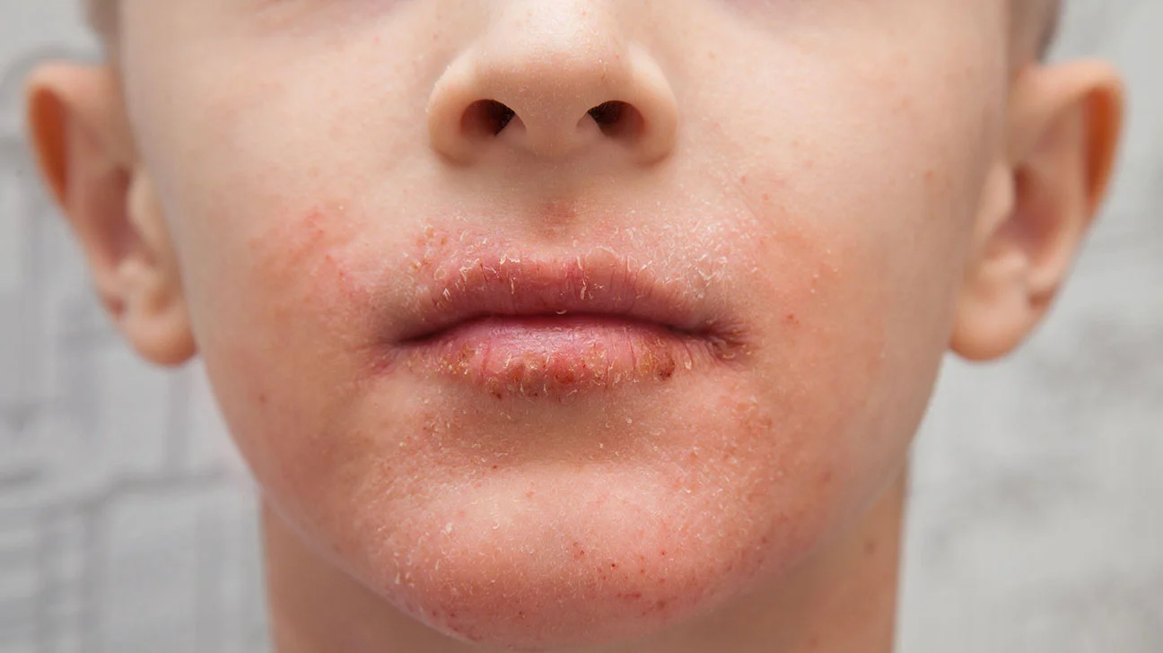 How to Get Rid of Eczema